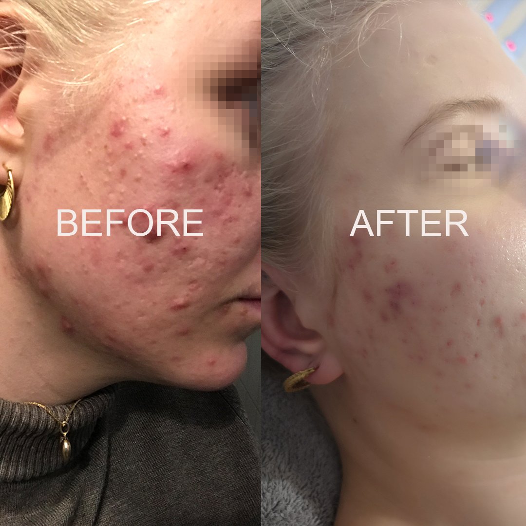 acne_skin_face_beore_after