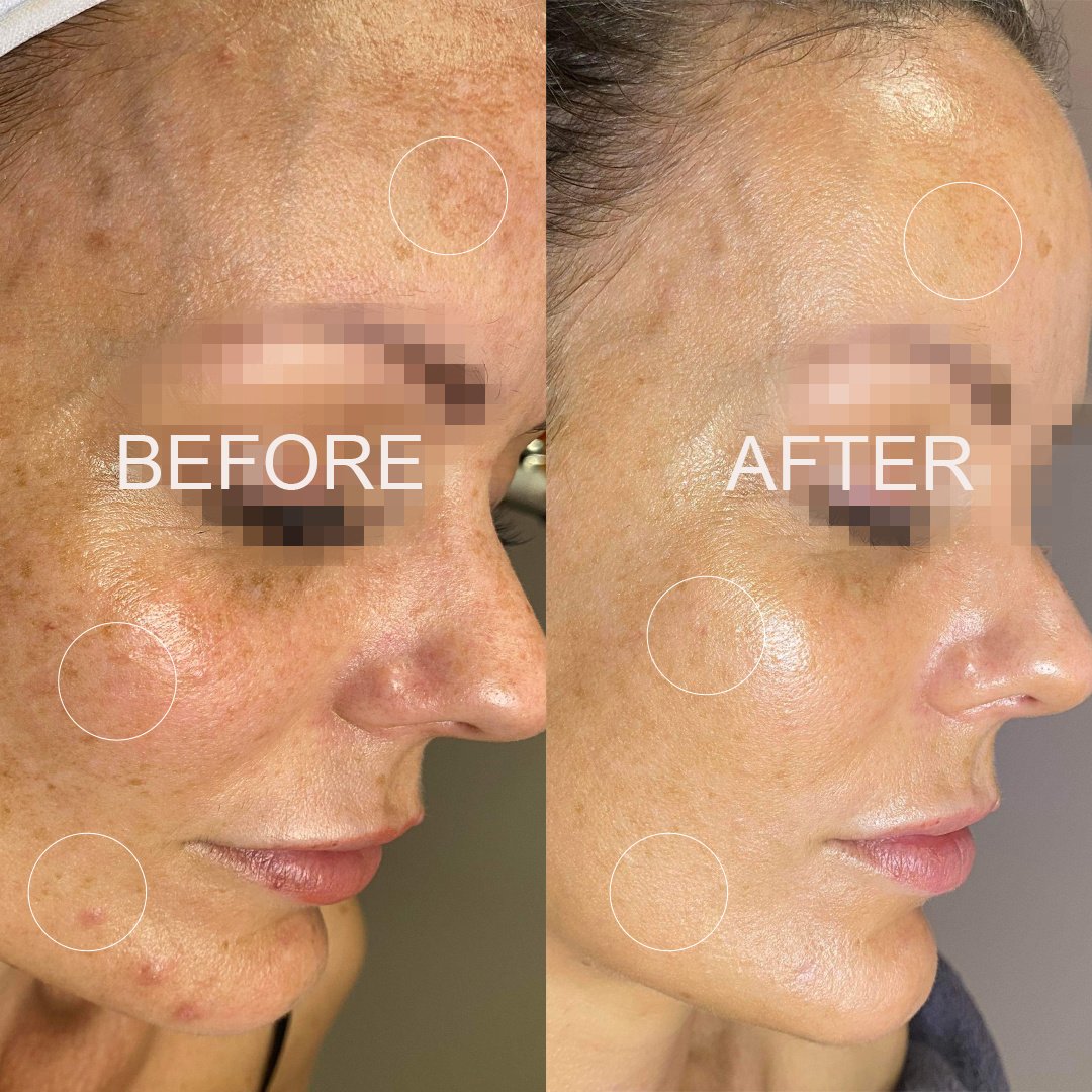 hyperpigminatation_skin_face_beore_after