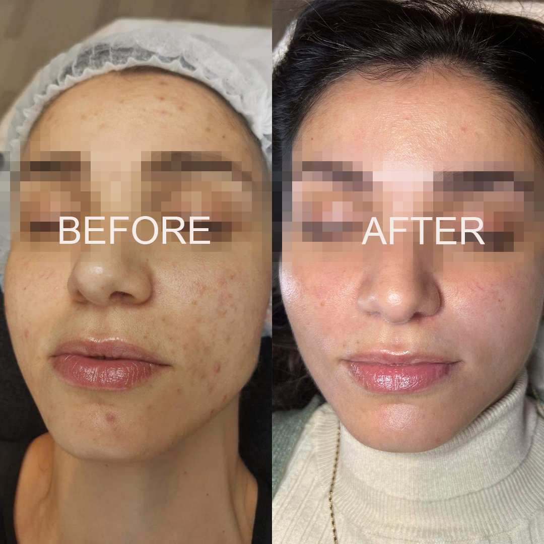 problematic_skin_face_beore_after